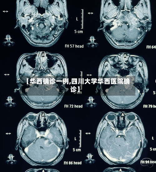 【华西确诊一例,四川大学华西医院确诊】-第2张图片