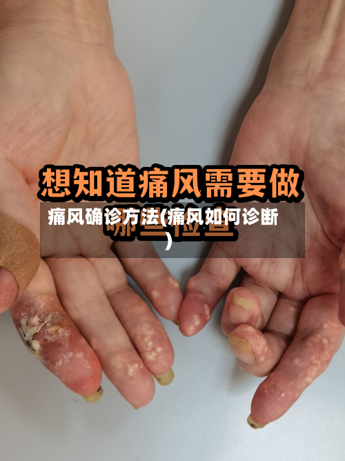 痛风确诊方法(痛风如何诊断)-第3张图片