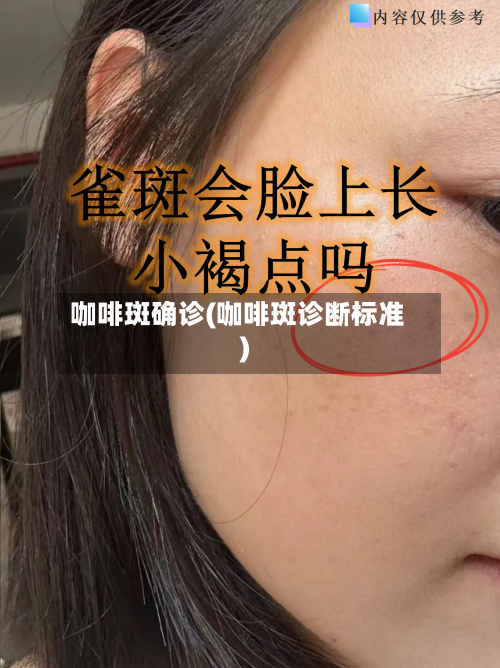 咖啡斑确诊(咖啡斑诊断标准)