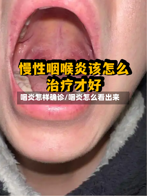 咽炎怎样确诊/咽炎怎么看出来