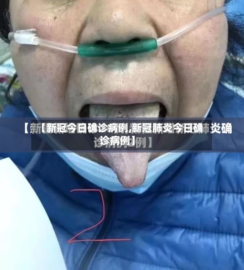 【新冠今日确诊病例,新冠肺炎今日确诊病例】-第1张图片