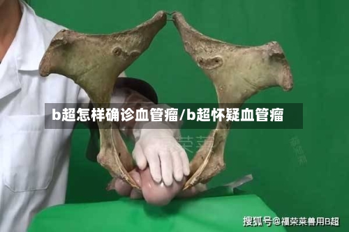 b超怎样确诊血管瘤/b超怀疑血管瘤-第1张图片