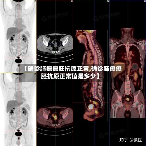 【确诊肺癌癌胚抗原正常,确诊肺癌癌胚抗原正常值是多少】-第2张图片