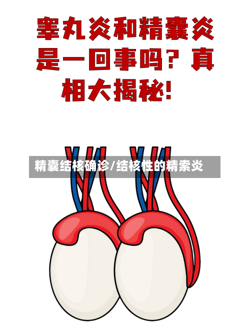 精囊结核确诊/结核性的精索炎