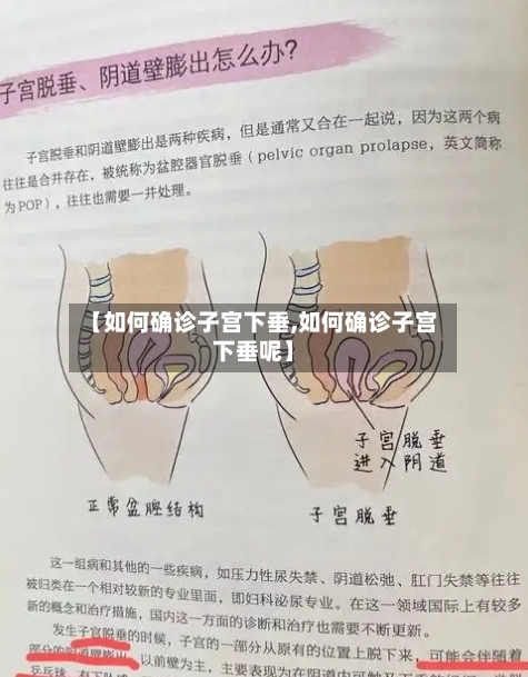 【如何确诊子宫下垂,如何确诊子宫下垂呢】-第1张图片