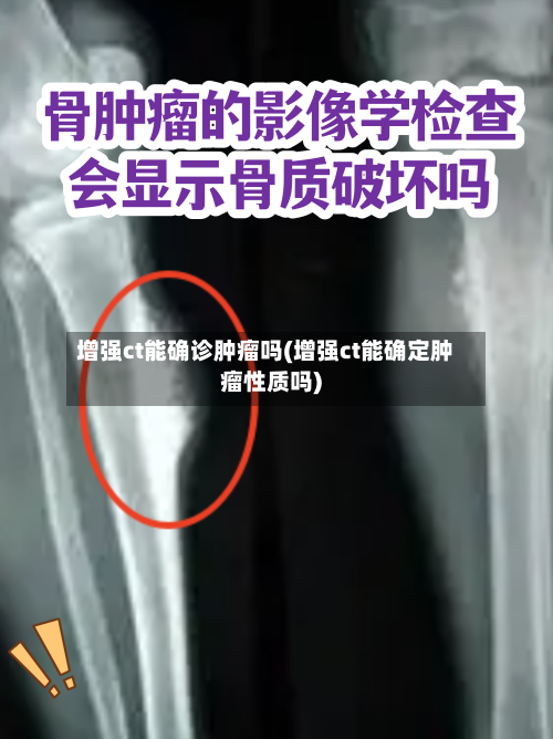 增强ct能确诊肿瘤吗(增强ct能确定肿瘤性质吗)