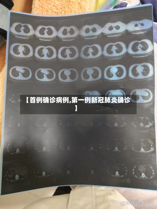 【首例确诊病例,第一例新冠肺炎确诊】-第2张图片