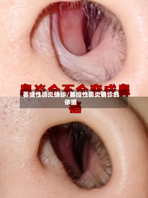 萎缩性鼻炎确诊/萎缩性鼻炎确诊的依据