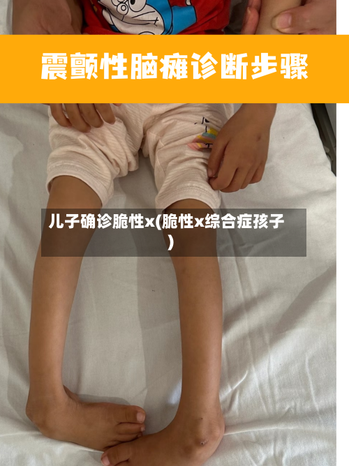 儿子确诊脆性x(脆性x综合症孩子)