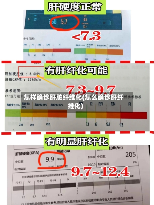 怎样确诊肝脏纤维化(怎么确诊肝纤维化)