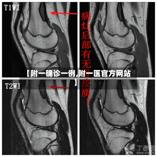 【附一确诊一例,附一医官方网站】