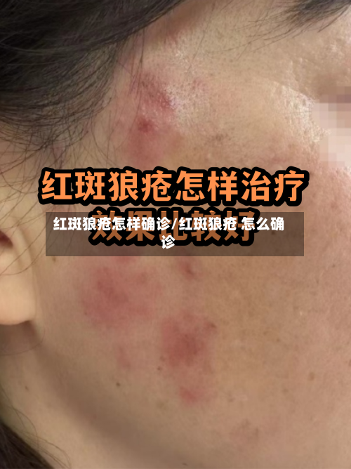 红斑狼疮怎样确诊/红斑狼疮 怎么确诊