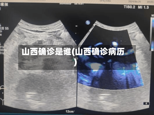 山西确诊是谁(山西确诊病历)