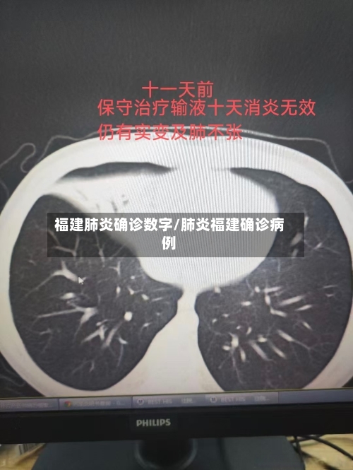 福建肺炎确诊数字/肺炎福建确诊病例