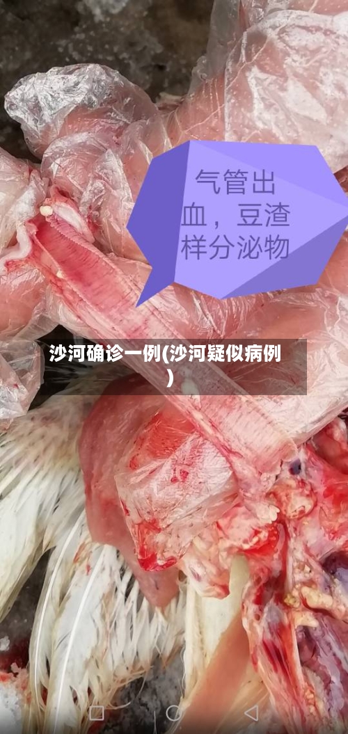 沙河确诊一例(沙河疑似病例)