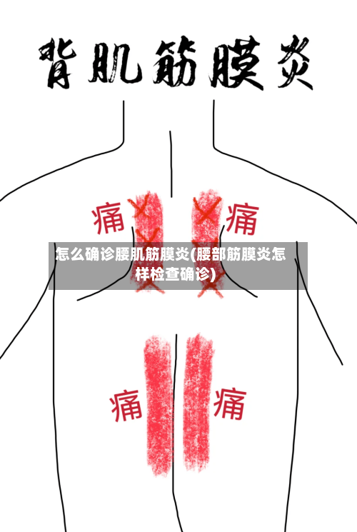 怎么确诊腰肌筋膜炎(腰部筋膜炎怎样检查确诊)