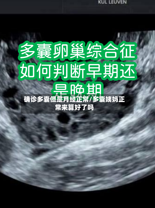 确诊多囊但是月经正常/多囊姨妈正常来算好了吗-第3张图片