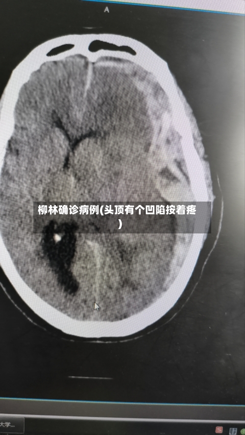 柳林确诊病例(头顶有个凹陷按着疼)