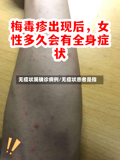 无症状属确诊病例/无症状患者是指